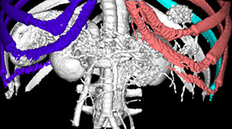 CT of a patient obtained from Christiana Hospital in Delaware. We colored some portions to show automatic segmentation. We later automatically segmented the liver tumor on the upper right.