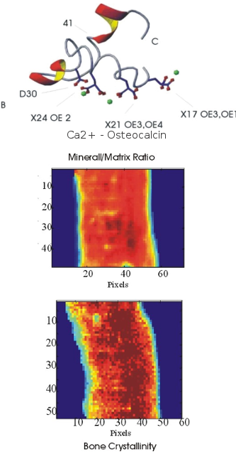 The Role of Osteocalcin in Normal and Diseased Bone